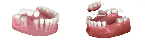 Removable partial denture models